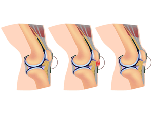 Three comparative knee joint illustrations: normal knee – with inflammation – with degeneration