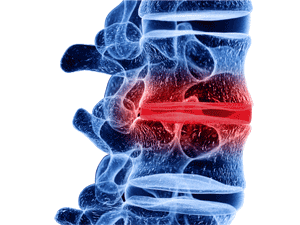 Illustration of lower back (lumbar) disc degeneration