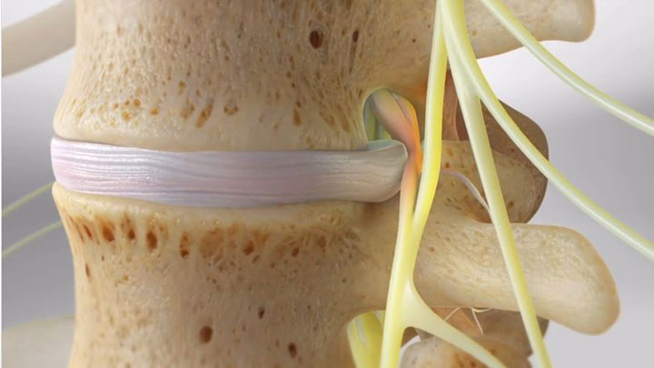 Bulging Disc: Difference from a Herniated Disc
